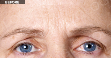 Before: Forehead & eye area (frontal): before vs after (labels are burned into Avologi's images).