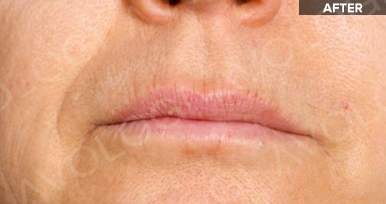 After: Lips / perioral lines: before vs after (labels are burned into Avologi's images).