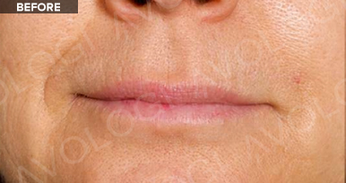 Before: Lips / perioral lines: before vs after (labels are burned into Avologi's images).