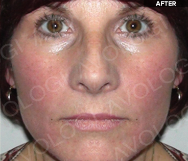 After: Full face (frontal): before vs after (labels are burned into Avologi's images).