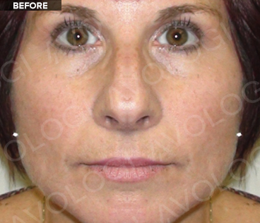 Before: Full face (frontal): before vs after (labels are burned into Avologi's images).