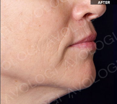 After: Lower face / jawline profile: before vs after (labels are burned into Avologi's images).