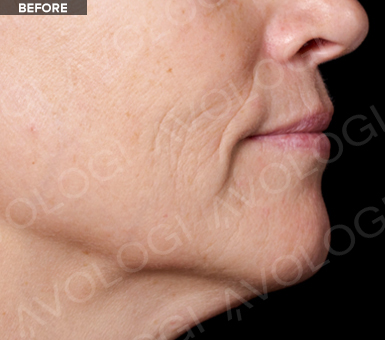 Before: Lower face / jawline profile: before vs after (labels are burned into Avologi's images).