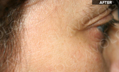 After: Crow's feet (profile): before vs after (labels are burned into Avologi's images).