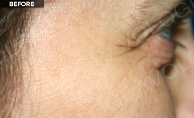 Before: Crow's feet (profile): before vs after (labels are burned into Avologi's images).