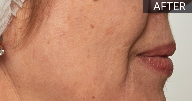 After: Cheek & nasolabial area (profile): before vs after, from the same Avologi usability-study image set.