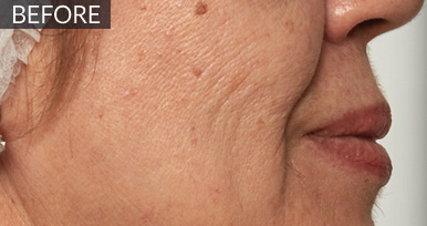 Before: Cheek & nasolabial area (profile): before vs after, from the same Avologi usability-study image set.