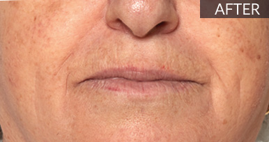 After: Perioral area: before vs after, from the same Avologi usability-study image set.
