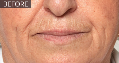 Before: Perioral area: before vs after, from the same Avologi usability-study image set.