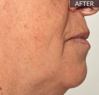 After: Lower face / jawline (profile): before vs after, from the same Avologi usability-study image set.