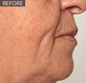 Before: Lower face / jawline (profile): before vs after, from the same Avologi usability-study image set.
