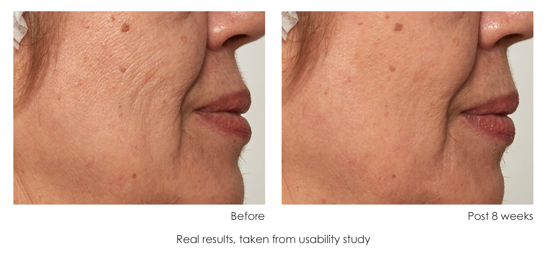 Composite published by Avologi: cheek/nasolabial wrinkles, 'Before' vs 'Post 8 weeks' ('Real results, taken from usability study').
