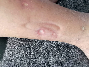 Before: Diabetic leg ulcers in an 84-year-old woman: first observation (Figure 1) vs complete healing after 30 days (Figure 5). Single case report.