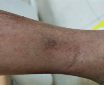 After: Diabetic leg ulcers in an 84-year-old woman: first observation (Figure 1) vs complete healing after 30 days (Figure 5). Single case report.