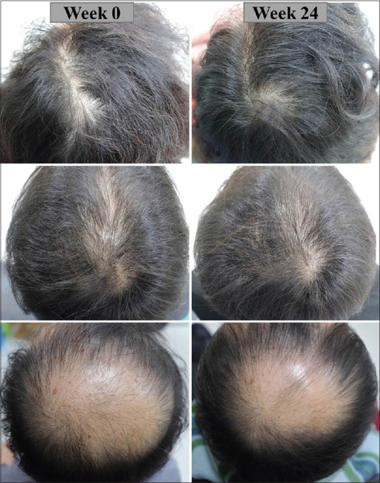 Global scalp photographs of 3 participants at baseline and week 24.