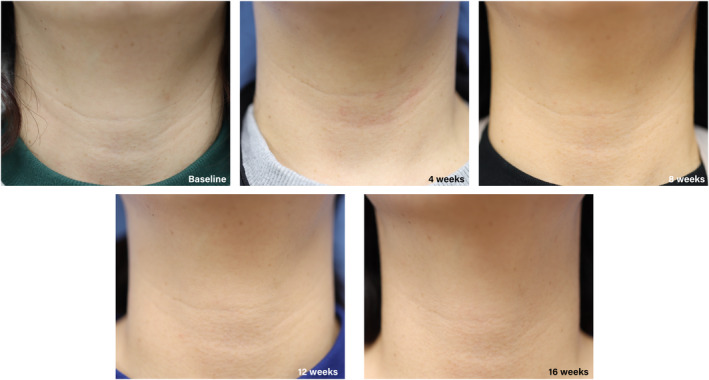 Neck wrinkles before and after device use (Figure 2, shown as published).
