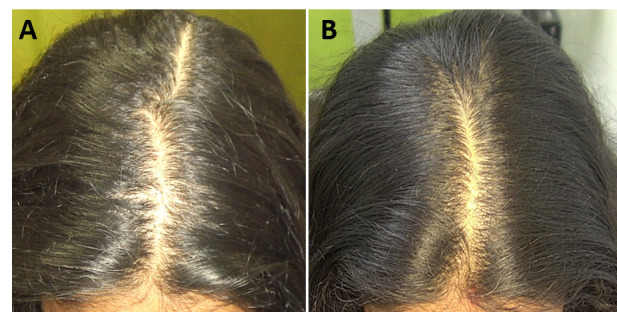 Androgenetic alopecia, female patient: central parting before (A) and after 14 sessions (B), 4-month follow-up.