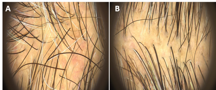 Dermatoscopy of the scalp before (A) and at the 4-month follow-up (B).