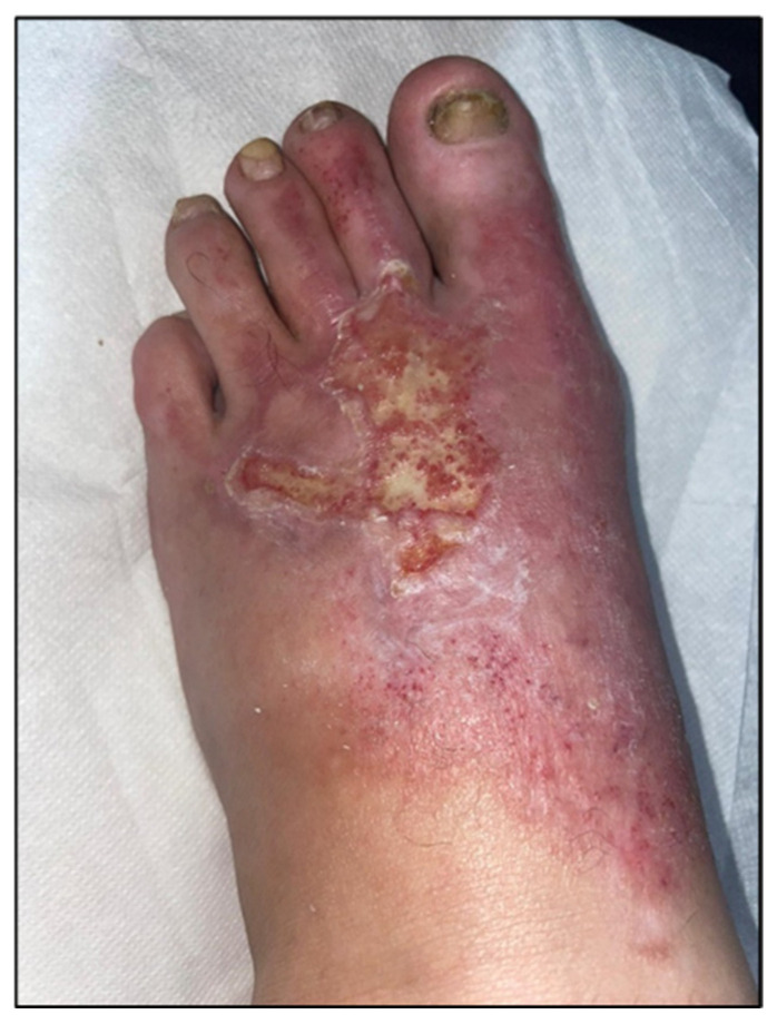 After: Post-burn lesion, top of the foot: before and after 10 sessions (Figures 3 & 4).