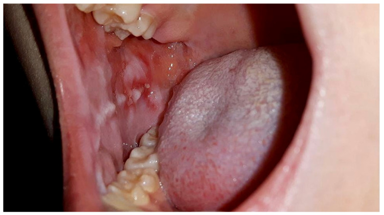 Before: Chemotherapy-induced oral mucositis (inside of the cheek) in a 15-year-old: grade 3 before PBM vs grade 1 after two sessions, 96 h later.