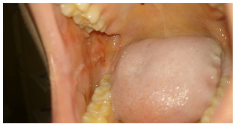 After: Chemotherapy-induced oral mucositis (inside of the cheek) in a 15-year-old: grade 3 before PBM vs grade 1 after two sessions, 96 h later.
