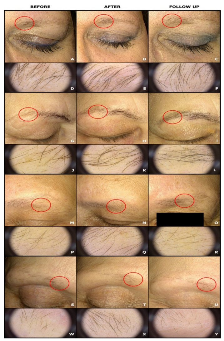 Eyebrow loss in frontal fibrosing alopecia: clinical and trichoscopic images before, after 10 LED irradiations, and at post-treatment follow-up (thicker hairs after treatment; partly reduced again at follow-up).